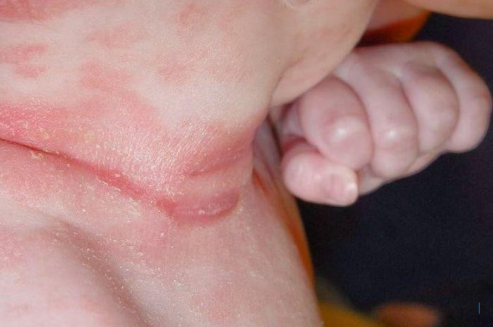 5 Cara Sederhana Mengatasi Leher Merah dan Lecet pada Bayi